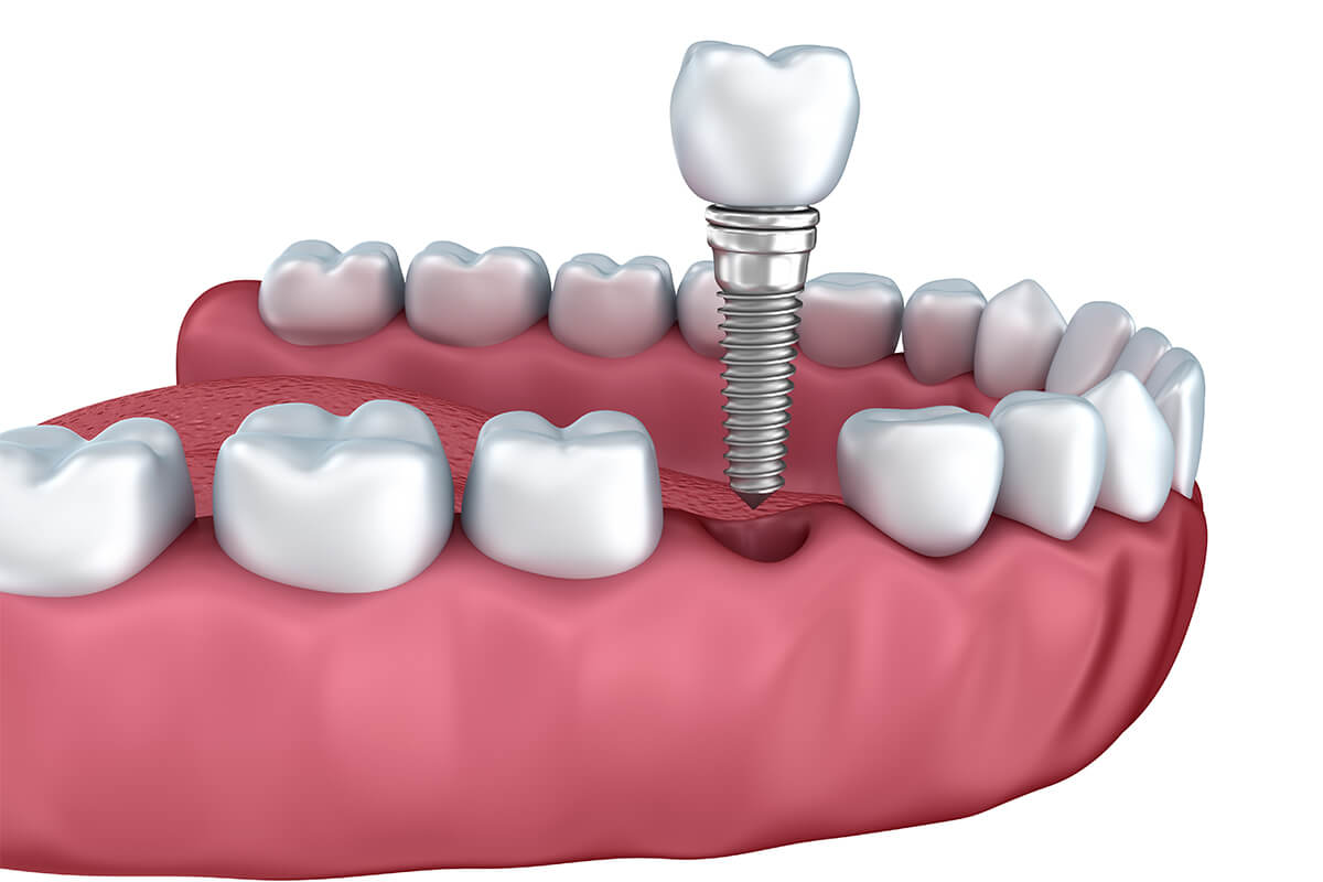 Dental Implants Benefits in Staten Island NY Area