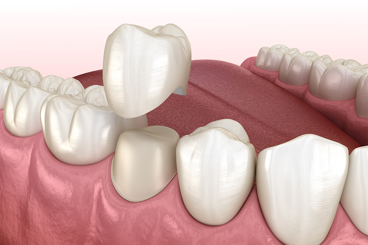 Dentist for Crowns in Staten Island NY Area